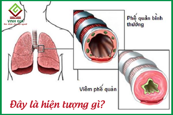 Viêm phế quản: Nguyên nhân, dấu hiệu và cách điều trị