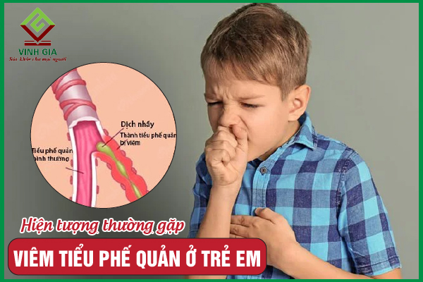 Viêm tiểu phế quản ở trẻ em: Nguyên nhân, dấu hiệu và điều trị
