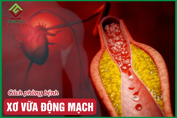 8 cách phòng bệnh xơ vữa động mạch bạn cần biết