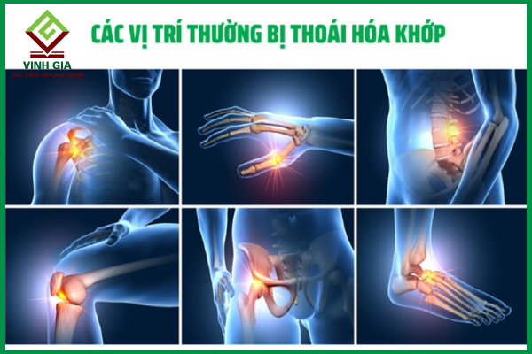 Điểm danh các vị trí thường bị thoái hóa khớp