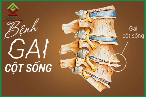 Gai cột sống: Nguyên nhân và cách điều trị hiệu quả
