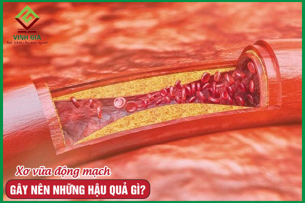 Bệnh xơ vữa động mạch gây ra những hậu quả gì?