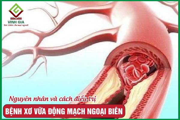 Xơ vữa động mạch ngoại biên – Những điều cần phải biết