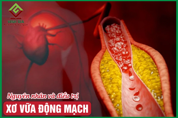 Xơ vữa động mạch: Nguyên nhân, dấu hiệu và cách cải thiện