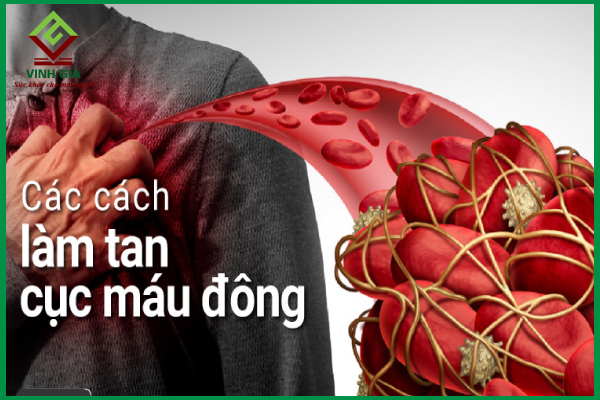 Cách làm tan huyết khối hiệu quả, ngăn ngừa tai biến