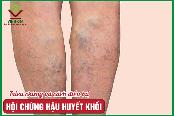 Tổng hợp các thông tin về hội chứng hậu huyết khối