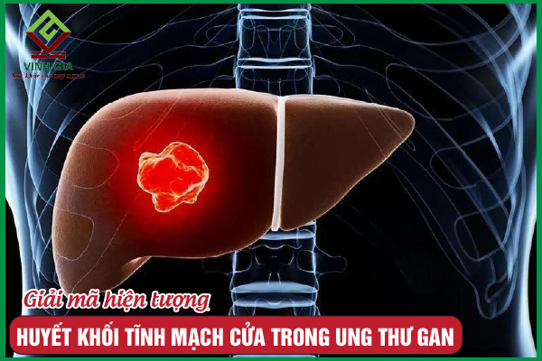 HUYẾT KHỐI TĨNH MẠCH LÁCH THƯỜNG GẶP Ở NGƯỜI VIÊM TỤY MẠN