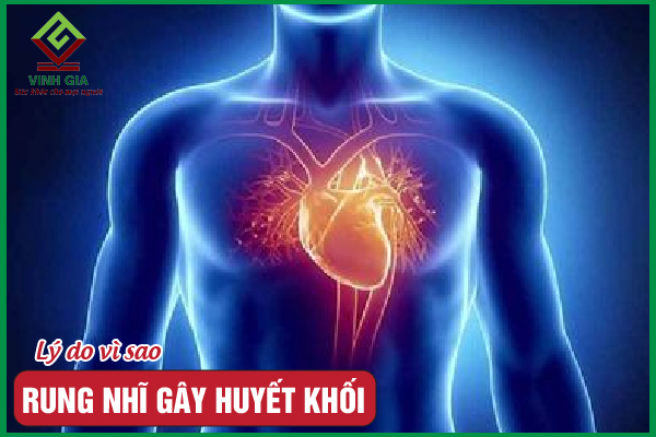 Đi tìm nguyên nhân vì sao rung nhĩ gây huyết khối?