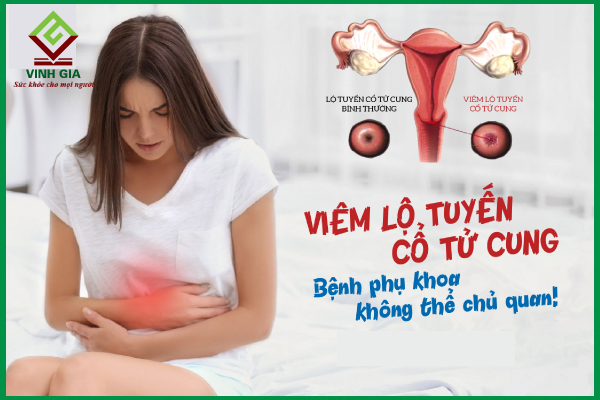 Viêm lộ tuyến cổ tử cung và các cấp độ của bệnh