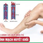 Viêm tĩnh mạch huyết khối: Nguyên nhân và tránh biến chứng