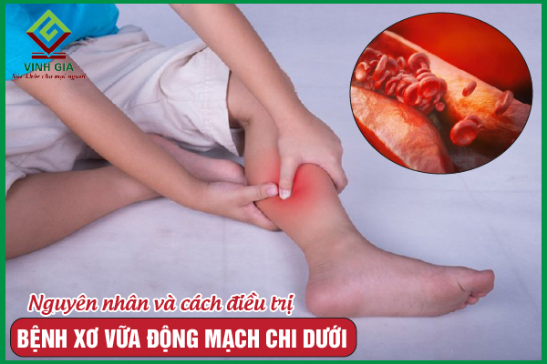 Xơ vữa động mạch chi dưới: Nguyên nhân, dấu hiệu và giải pháp