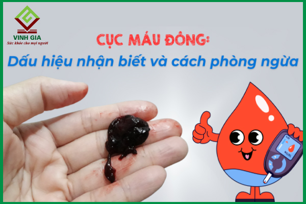 Biến chứng nguy hiểm từ cục máu đông và cách phòng ngừa