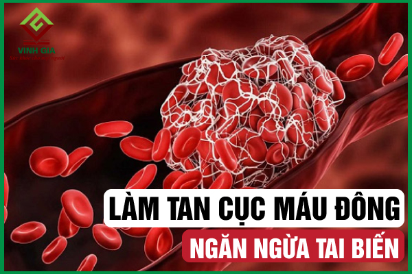 Các cách làm tan cục máu đông hiệu quả ngăn ngừa tai biến
