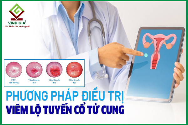 Các cấp độ viêm lộ tuyến cổ tử cung và điều trị theo từng cấp độ