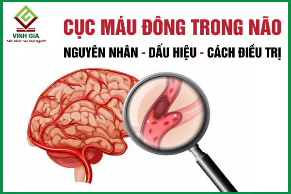 Cảnh báo nguy hiểm: Sự hình thành cục máu đông trong não