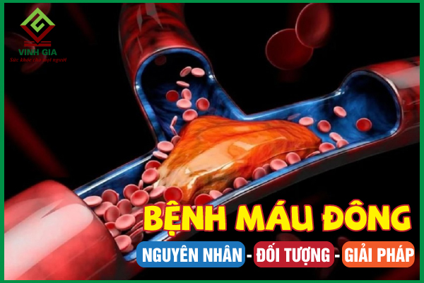 Tìm hiểu về bệnh đông máu để biết cách phòng ngừa hiệu quả