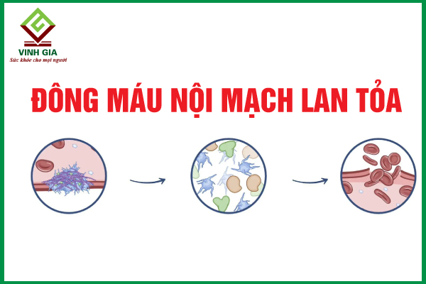 Những điều nên biết về đông máu nội mạch lan tỏa