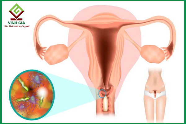 Viêm âm đạo – “Thủ phạm” phổ biến gây ngứa rát trong mùa hè