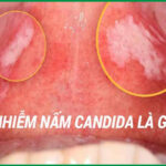 Nhiễm nấm Candida vào mùa nóng: Nguyên nhân và cách phòng tránh