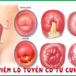 Bệnh phụ khoa dễ gặp mùa nắng nóng: Viêm lộ tuyến cổ tử cung